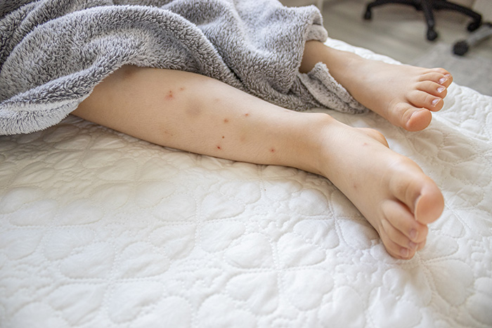Boutons sur les jambes d'un enfant causés par des piqûres de punaises de lit